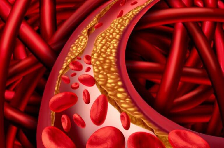 Veia com camada de gordura quase entupindo a passagem